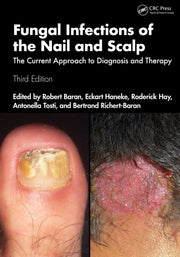 Fungal Infections Of The Nail And Scalp By Baran  Robert