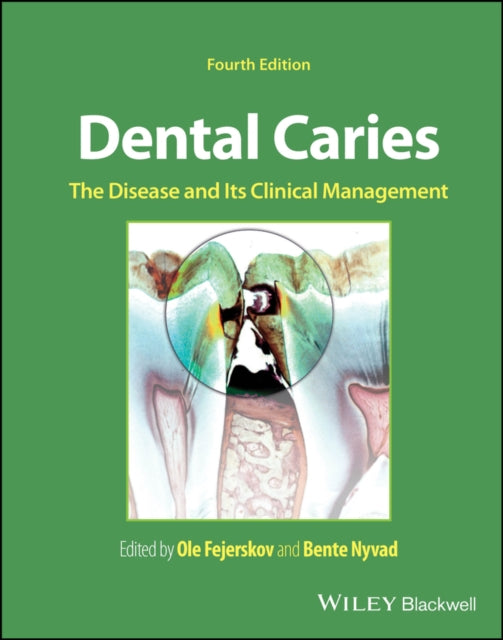 Dental Caries The Disease And Its Clin By Ole Fejerskov