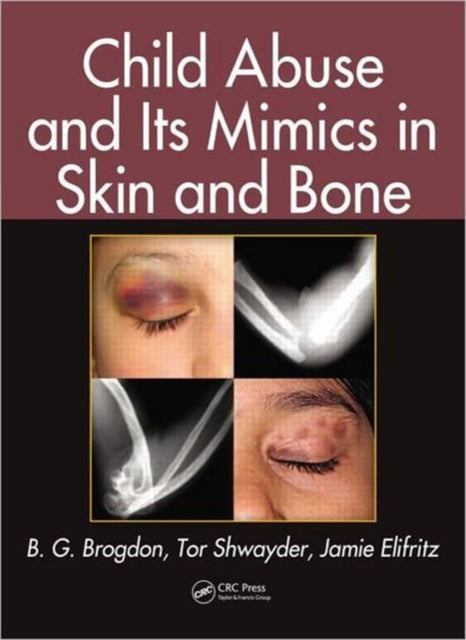 Child Abuse & Its Mimics In Skin & Bone
