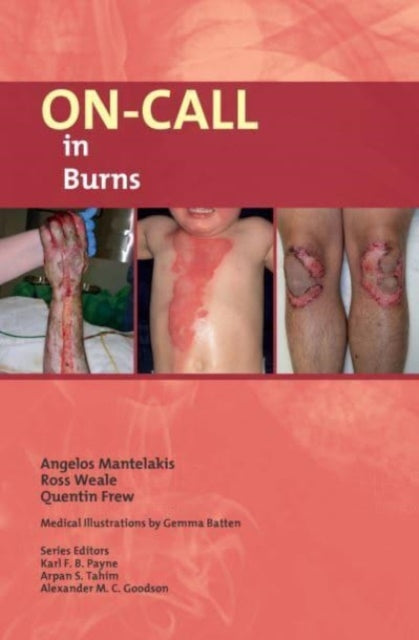 Oncall In Burns