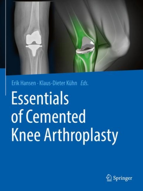 Essentials Of Cemented Knee Arthroplasty