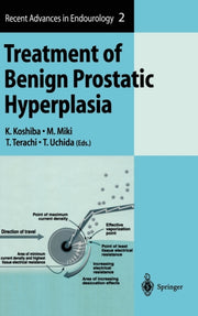 Treatment Of Benign Prostatic Hyperplasi