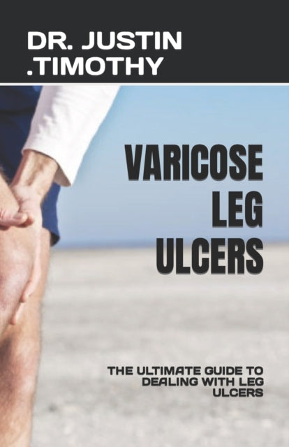 Varicose Leg Ulcers: The Ultimate Guide